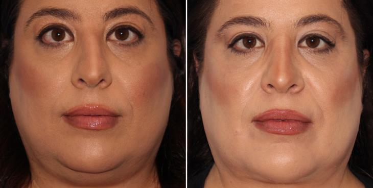 Atlanta GA Scarless Nose Surgery Results